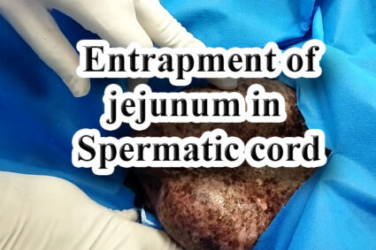 Entrapment of jejunum in Spermatic cord