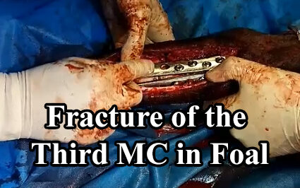 Fracture of MC bone after previous surgery