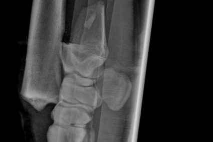 Radial Fracture