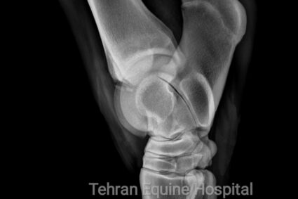 Subchondral bone Fragments in tarsal joint