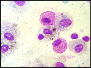 Bronchoalveolar Lavage (BAL)